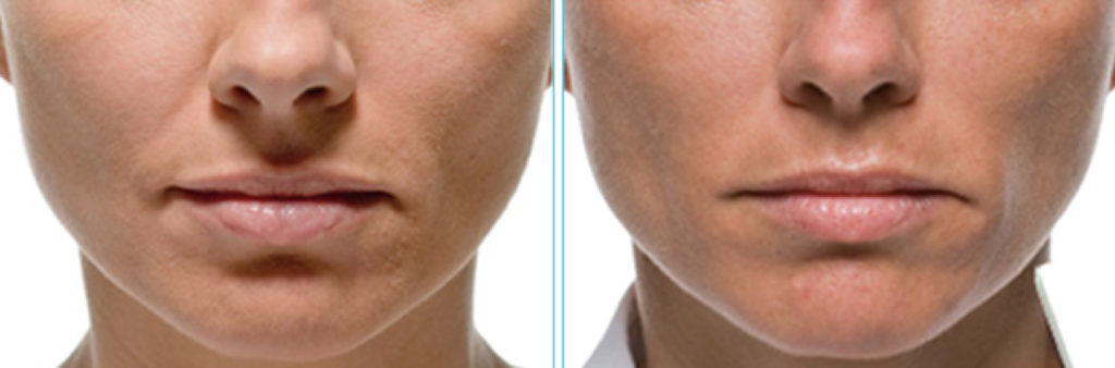 Injection De Radiesse Dr Brunner Dermatologue Monaco